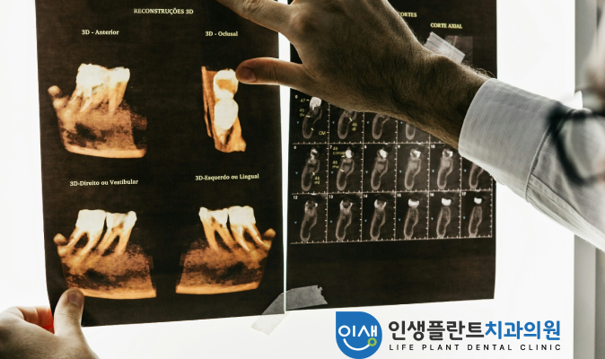 컴퓨터 분석 디지털 임플란트